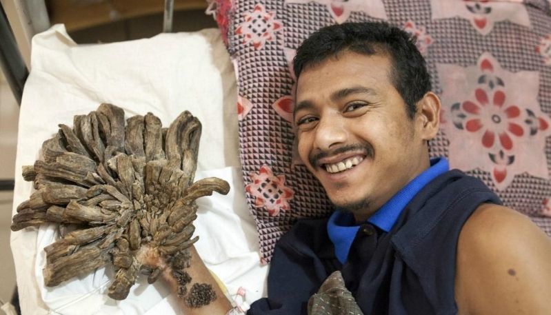 bangladeshi-tree-man-begs-for-hand-amputation-to-ease-pain__83973_.jpg